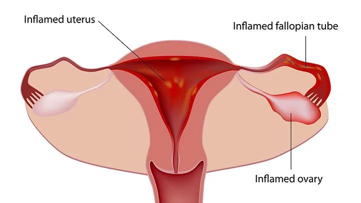 Best Gynaecologist for Period Pain in Madhapur