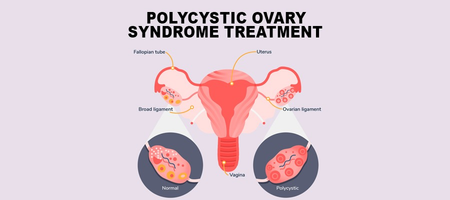 Best Specialist for PCOS and Period Pain in Gachibowli and Madhapur
