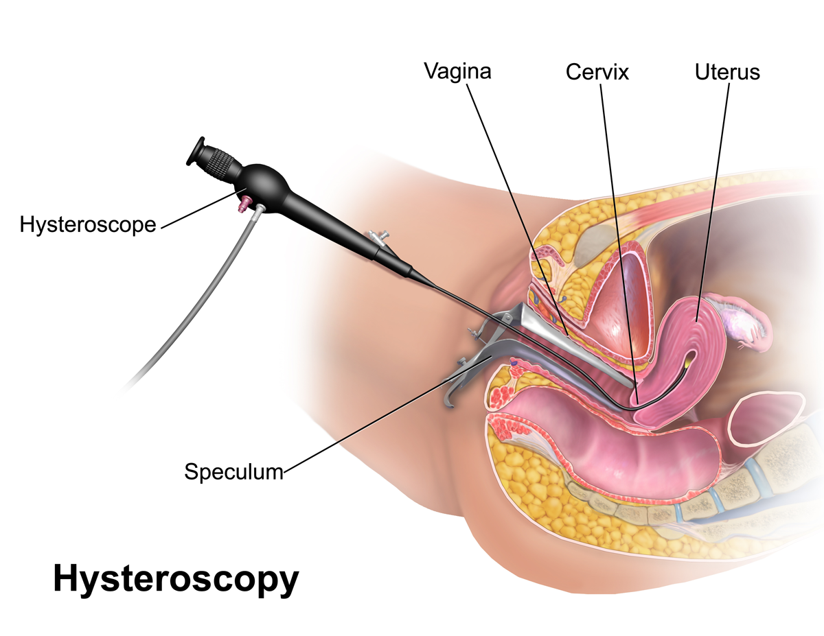 Hysteroscopy Procedure in Hyderabad