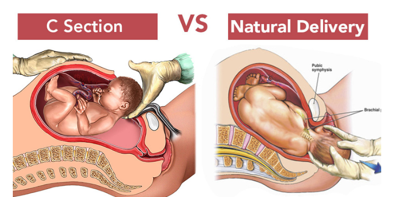 Best Doctors for Normal Delivery After C-Section in Gachibowli